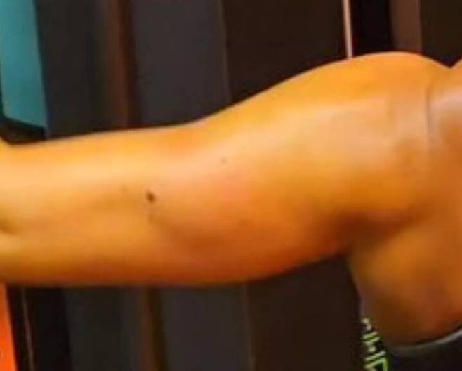 제인 머레이(46)는 4년 전 왼팔에 점이 생겼다. [사진=SNS]