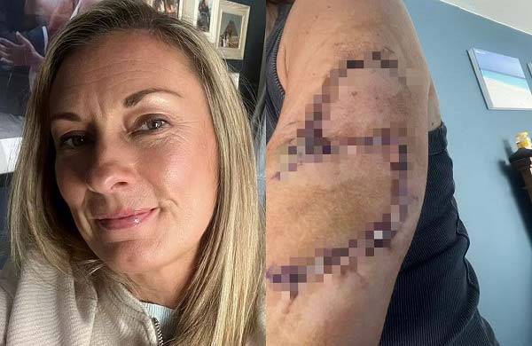 제인 머레이(46)는 4년 전 갑자기 왼팔에 점이 생겼는데, 알고 보니 흑색종 증상이었다./사진=데일리메일