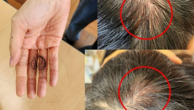 지난달 28일 부산의 한 초등학교에서 학생에게 폭행당한 교사가 전치 2주 진단을 받았다. 부산교사노조 제공