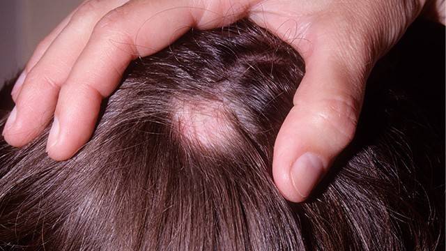 원형탈모증은 면역학적 이상으로 발생하는 자가면역질환이다｜출처: 클립아트코리아