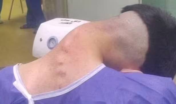 ‘머리떨굼증후군’에 걸린 20대 남성 [이란 알자흐라 대학병원=데일리메일]