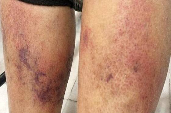 비브리오패혈증 증상. 서울신문DB