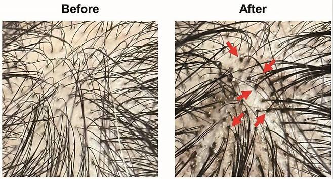 탈모 방지 샴푸 '그래비티'를 사용하기 전(왼쪽)과 후(오른쪽) 비교. 사용 후는 두꺼워진 모발이 모공에 꽉 끼어있는 모습이다. 폴리페놀 팩토리 제공