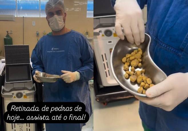 매일 2~3리터의 탄산음료를 마신 60대 남성이 방광에서 결석 35개를 제거하는 수술을 받았다. [사진=SNS]