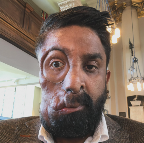 영국에서 신경섬유종증을 앓고 있는 30대 남성이 어린 시절부터 끊임없는 괴롭힘을 당해왔지만 온라인상에 자신의 이야기를 공유하면서부터 많은 사람들에게 희망이 되고 있다는 사연이 전해졌다. 인스타그램 캡처