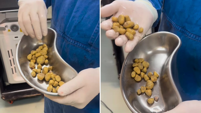 몸에서 나온 결석들. [사진 = drthalesandrade 인스타그램]