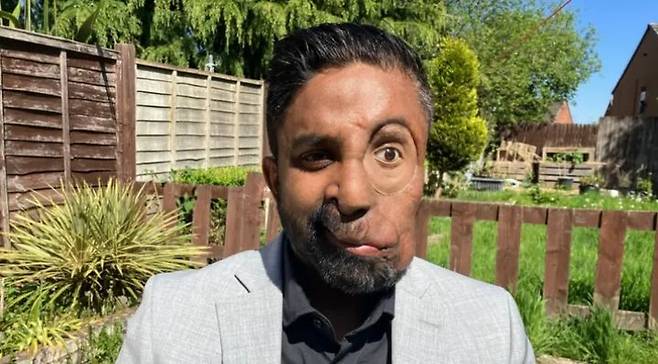 [뉴시스] 19일(현지시각) 영국 BBC 방송은 선천적 질환을 딛고 긍정의 메시지를 전하고 있는 아밋 고스(35)의 이야기를 소개했다. (사진=BBC) *재판매 및 DB 금지