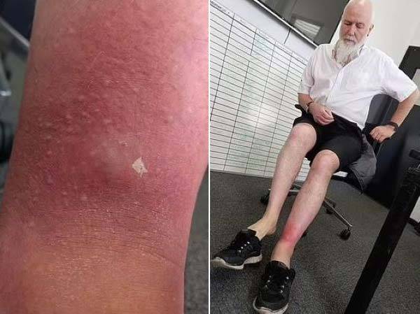 거미에게 물려 봉와직염을 진단받은 영국 60대 남성의 사연이 공개됐다. 사진은 봉와직염으로 인해 발목이 붓고 고름이 생긴 모습./사진=데일리 메일