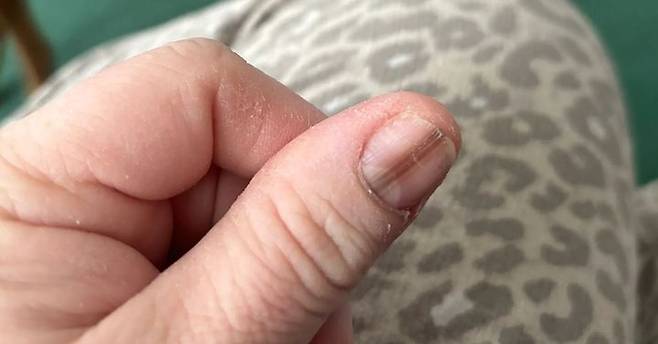 [서울=뉴시스] 미국의 한 여성이 틱톡 영상을 보고 병원을 찾아갔다가 손발톱하흑색종 진단을 받았다. (사진 = SWNS 캡처) 2025.05.22. *재판매 및 DB 금지