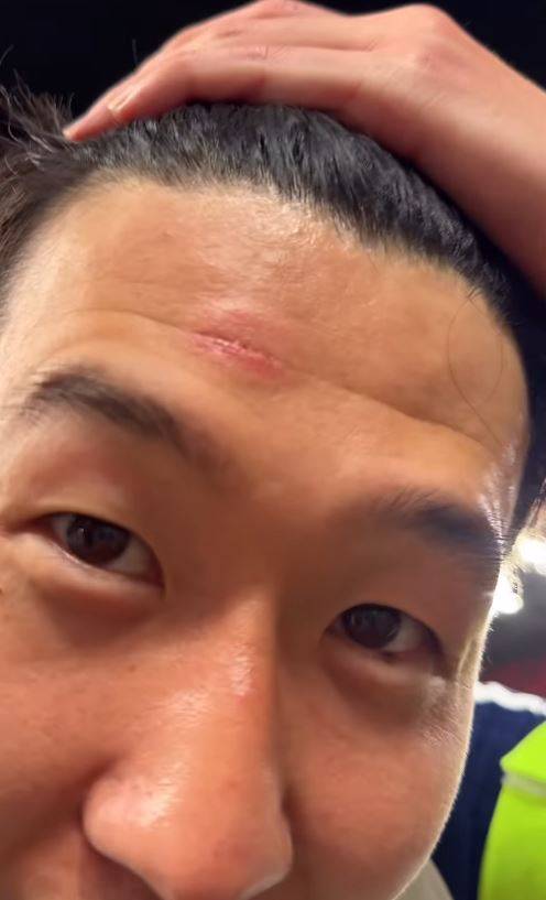 22일 토트넘 공식 사회관계망서비스(SNS)를 통해 공개된 영상에는 손흥민이 상처 부위를 손으로 가리키며 해맑게 웃고는 '트로피를 들어 올리는 순간 누가 뒤에서 밀었다. 그래서 트로피에 이마를 부딪혀 이렇게 상처가 났다'고 말하는 장면이 담겨 있었다. 팬들은 해당 영상 댓글란을 통해 열렬히 반응했다. '해리포터보다 멋진 상처', '진짜 챔피언의 상징', '15년의 집념이 새겨진 흔적'이라는 댓글이 붙었다.  토트넘 홋스퍼