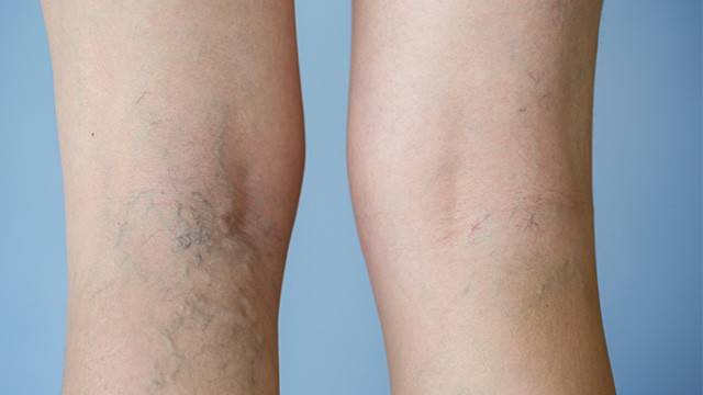 하지정맥류는 다리 정맥이 돌출되는 질환이다|출처: 게티이미지뱅크