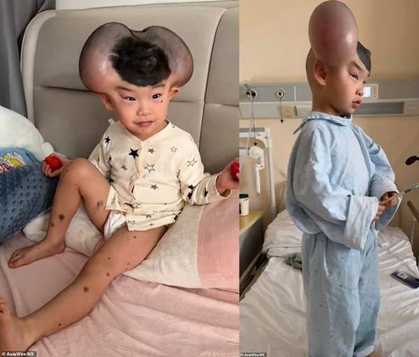 선천성 멜라닌 세포 모반증 치료를 위해 피부 확장술을 받아 머리 양쪽이 미키마우스와 같은 모양이 된 치바오의 모습./사진=데일리 메일
