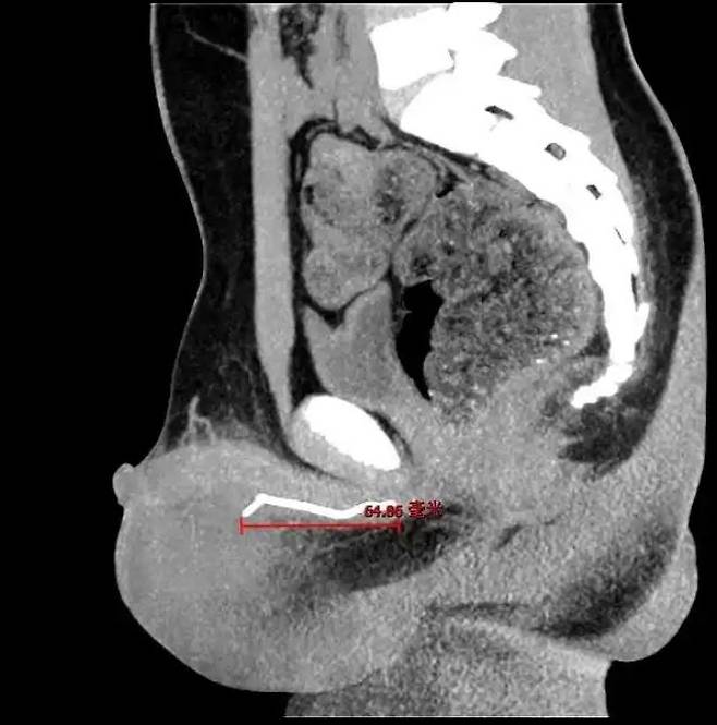 [서울=뉴시스]중국의 한 10세 소년이 하체 통증으로 병원을 찾았다가 몸속에서 7cm 길이의 철사가 발견돼 충격을 주고 있다.(사진=장강일보) *재판매 및 DB 금지