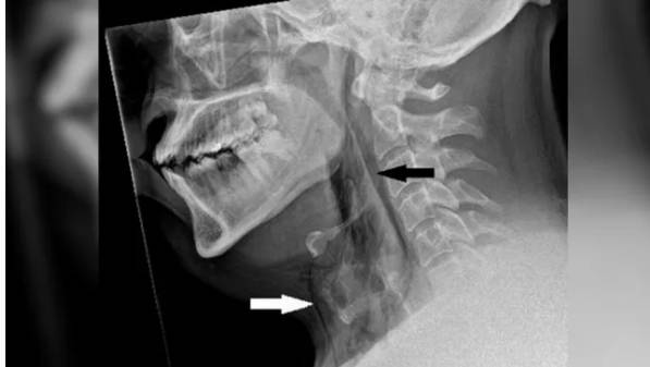기관지가 찢어진 남자의 X-선 이미지로  흰색과 검은색 화살표 부위가 피부 아래에 갇힌 공기 영역이다.  재채기를 참다 기관지가 찢어진 첫 사례다. [BMJ Case Reports 캡쳐]