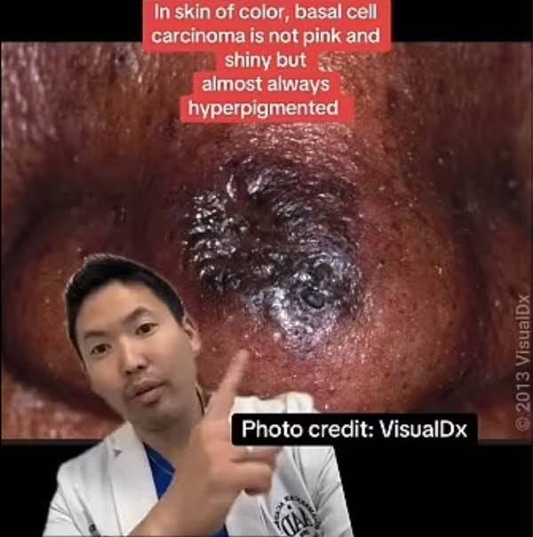 피부과 전문의 다니엘 수가이 박사는 딱지가 생기고 피가 나는 작은 여드름 같은 것이 계속 반복된다면 피부암일 수 있다고 말했다​./사진=영국 데일리메일 캡처