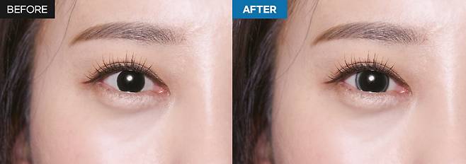 아이링 수술 전후 사진