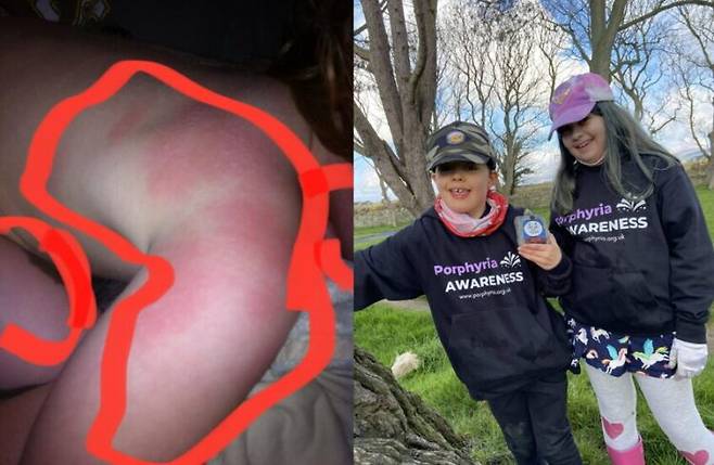 햇빛에 나가기만 해도 극심한 알레르기 반응이 일어나 고통을 호소하는 10대 남매의 사연이 소개됐다. [사진=SNS]