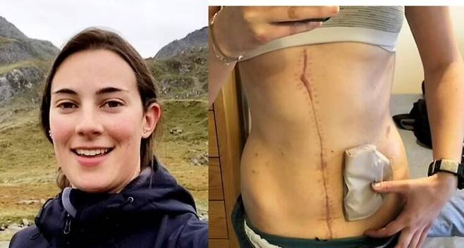 희귀 암으로 장기 13개를 잃고도 삶을 포기하지 않는 30대 여성의 사연이 소개됐다. [사진=SNS]