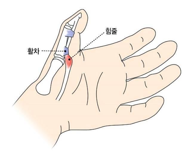 방아쇠 손가락과 관련된 힘줄과 활차의 설명도. 강동경희대병원 제공