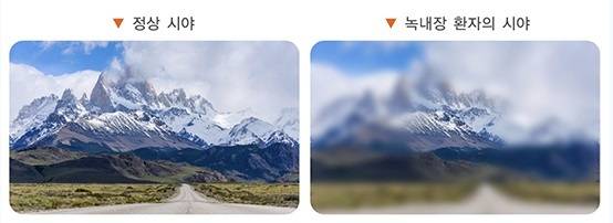 정상 시야와 녹내장 환자의 시야 차이. 질병관리청