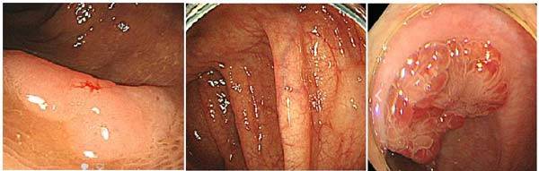 왼쪽부터 대장암 발병 위험이 매우 높은 평탄융기형 선종, 목 없는 톱니 병변, 전통 톱니 선종 등./사진=대한위대장내시경학회 제공