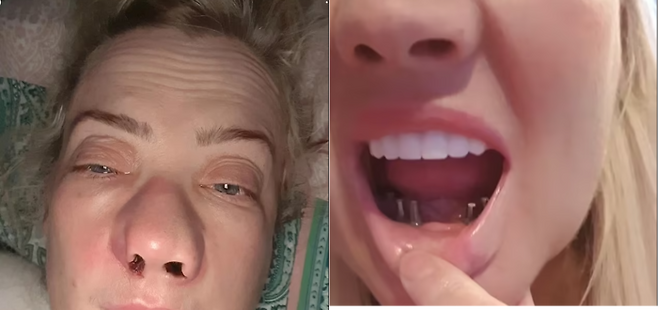 영국 여성 리안느가 터키에서 임플란트 수술을 받고 후유증을 겪고 있다. [사진 = SNS 캡처]