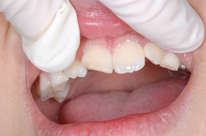 치아 파절 [경희의료원 제공]