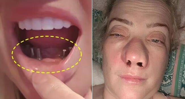 저렴한 치과를 찾다가 튀르키예에서 임플란트 수술을 받은 여성이 1년째 후유증을 앓고 있는 사연이 공개됐다. [사진=SNS]