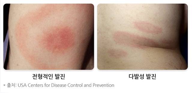 라임병 환자의 전형적인 발진 형태(왼쪽)과 다발성 발진. 질병관리청