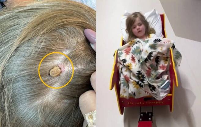 가족과 캠핑을 떠났던 4세 여아가 갑작스런 전신 마비 증세를 보여 병원으로 이송된 후, '진드기 마비증(tick paralysis)' 진단을 받고 회복된 사례가 알려졌다. [사진=SNS]