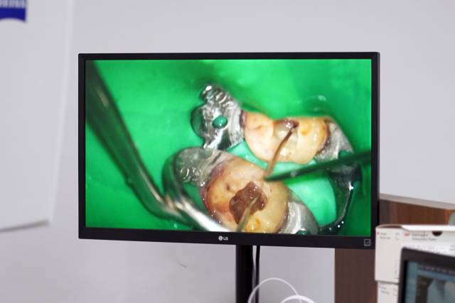 충치 치료 모습. 부산대치과병원 제공