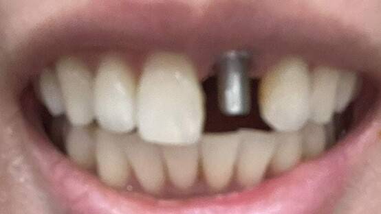 ㄱ씨가 운영하는 치과의 또다른 피해자 변아무개(33)씨도 임플란트 치료를 마치지 못한 채 방치됐다고 말했다. 사진은 임플란트 심을 박아놓은 변씨의 치아. 변씨 제공