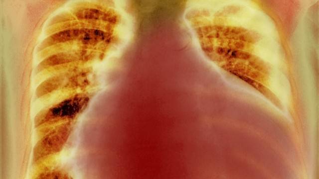 심비대증은 위험한 심장 질환의 신호일 수 있다｜출처: 클립아트코리아