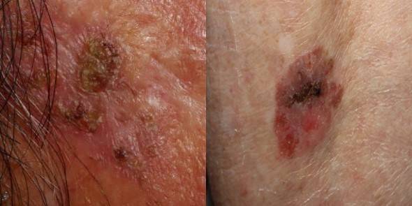 (사진 왼쪽부터) 피부암 전구증인 광선각화증과 보웬병./사진=서울대병원