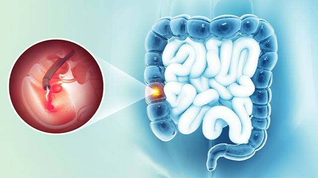 대장내시경 검사는 대장암을 비롯한 대장 질환을 예방·조기발견할 수 있는 방법이다｜출처: 게티이미지뱅크