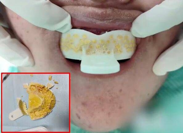 그는 실수로 인상재가 아닌 석고를 트레이에 부은 후, 이를 입에 넣었다. [사진=SNS]