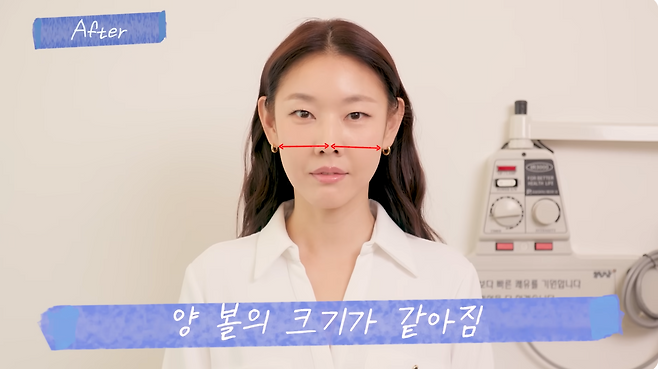 한혜진이 생애&nbsp;처음 받아본 침 성형으로 20분 만에 놀라운 차이를 느꼈다.&nbsp;유튜브 채널 ‘한혜진 Han Hye Jin’ 캡처