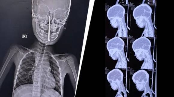 인도의 한 소년이 놀다가 실수로 넘어져 8㎝ 길이의 못이 뇌까지 박혔다. 인디아투데이 캡처