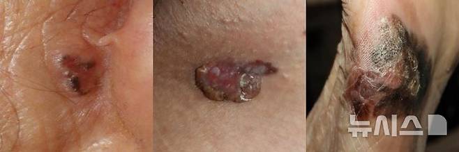 [서울=뉴시스]왼쪽부터 기저세포암, 편평세포암, 악성흑색종. (사진= 서울대병원 제공) 2025.06.06. photo@newsis.com.