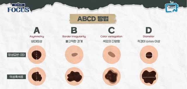 ABCD자가진단 체크포인트. 서울대병원