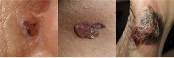 왼쪽부터 기저세포암, 편평세포암, 악성흑색종 [서울대병원 제공]