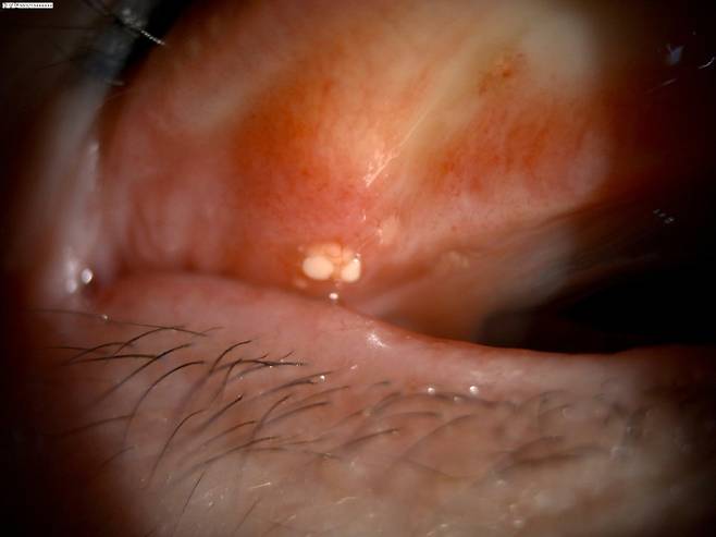 결막결석 사진 / 사진 =정근안과병원 제공