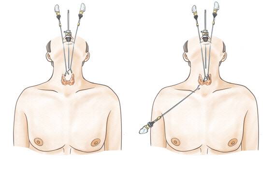 (좌)3포트 수술, (우)4포트 수술 1부.