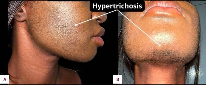 탈모 치료제로 널리 사용되는 미녹시딜(Minoxidil)의 부적절한 사용으로 다모증이 발생한 여성의 사례가 보고됐다. [사진=American Journal of Case Reports]