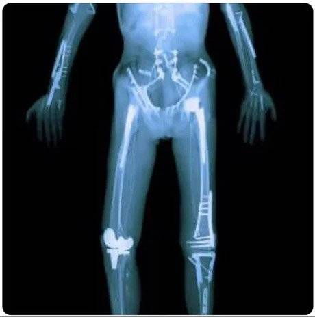 aKGYoG6_460swp.webp.ren.jpg 레저 스포츠인의 엑스레이