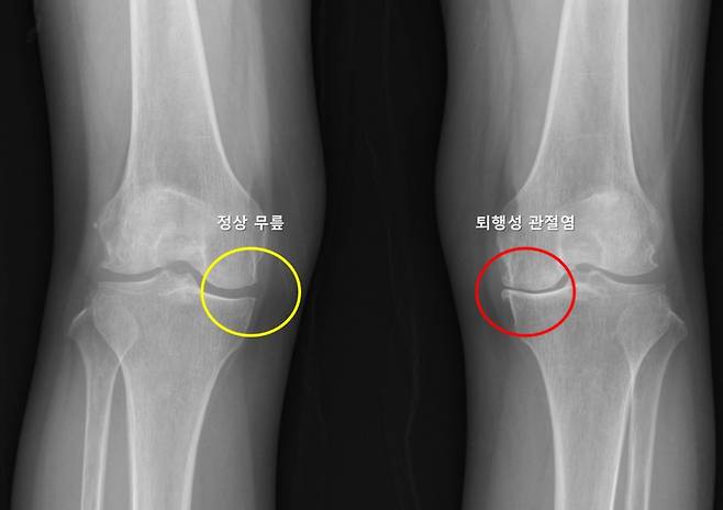 한쪽 다리에 무릎 퇴행성 관절염이 발생한 환자의 엑스레이(X-ray) 촬영 사진. 정상 무릎(노란 동그라미)은 관절 간격이 잘 유지되고 뼈 모양이 정상인데, 퇴행성 관절염(빨간 동그라미)은 관절 간격이 좁아지고 뼈 모양이 변형됐다. /사진=서울대병원