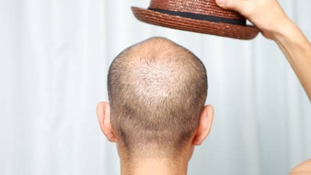 모자를 자주 쓰면 머리카락이 더 많이 빠질까?|출처: 게티이미지뱅크