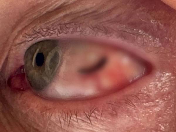 토니 엑솔(58)이 정글 탐험 도중 눈에 거머리가 들어갔다./사진=더 선