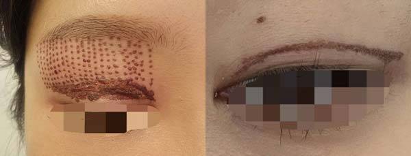 에스테틱 샵에서 플라즈마 기기로 쌍꺼풀 시술을 받은 이후의 모습/사진=네이버 카페 '여우야', 성형 정보 공유 커뮤니티 '성예사' 캡처