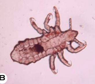 머릿니 확대 사진./사진=Journal of Mycology and Infection